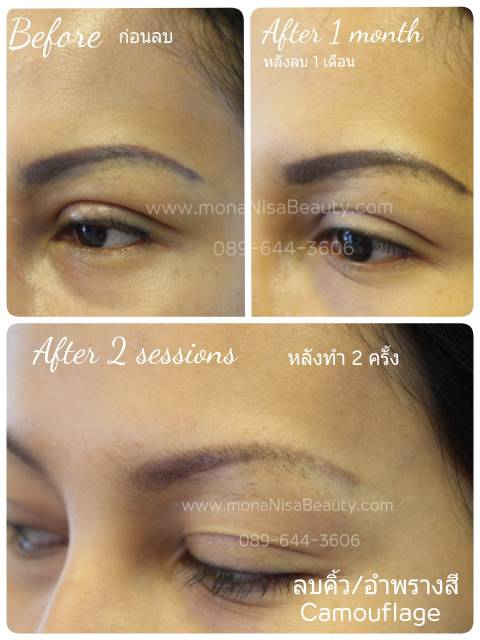 ลบรอยสักคิ้ว ตา ปาก