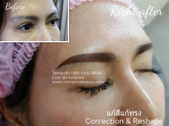 ลบรอยสักคิ้ว ตา ปาก