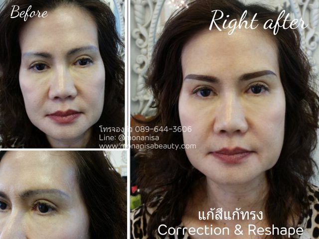 ลบรอยสักคิ้ว ตา ปาก