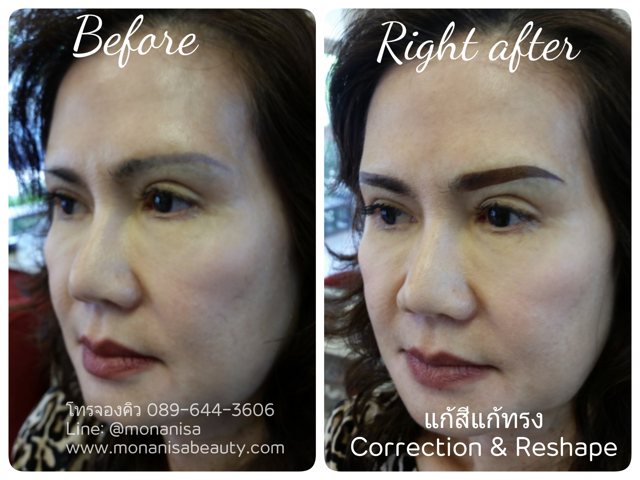 ลบรอยสักคิ้ว ตา ปาก