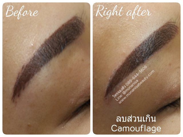 ลบรอยสักคิ้ว ตา ปาก