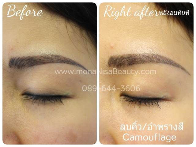 ลบรอยสักคิ้ว ตา ปาก