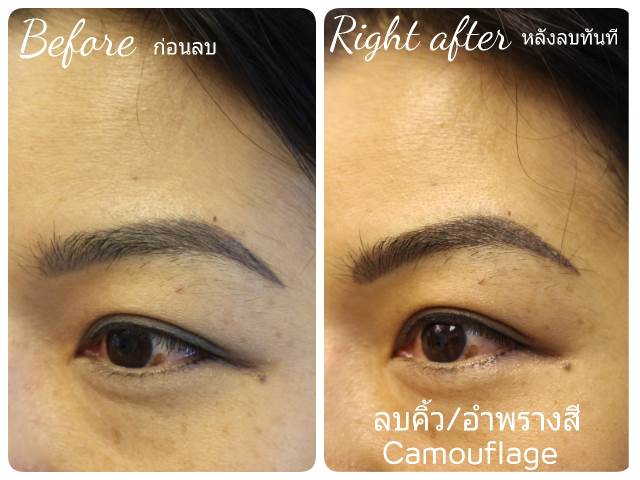 ลบรอยสักคิ้ว ตา ปาก