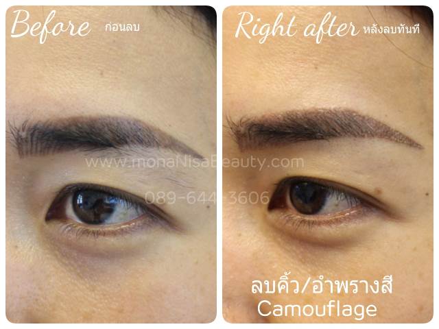 ลบรอยสักคิ้ว ตา ปาก