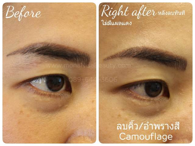 ลบรอยสักคิ้ว ตา ปาก