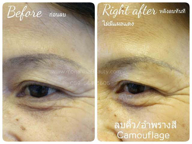 ลบรอยสักคิ้ว ตา ปาก