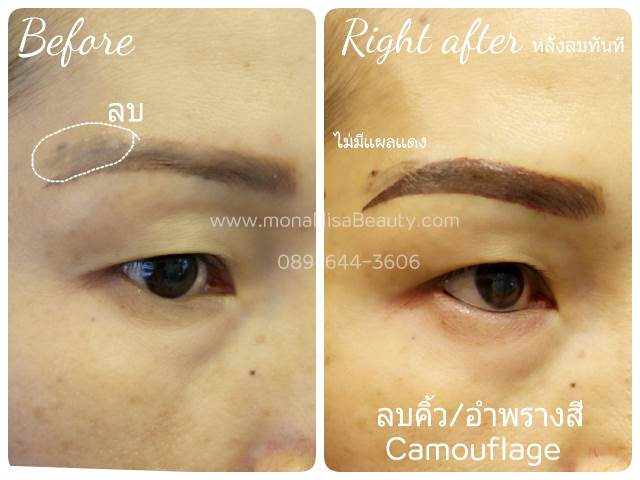 ลบรอยสักคิ้ว ตา ปาก