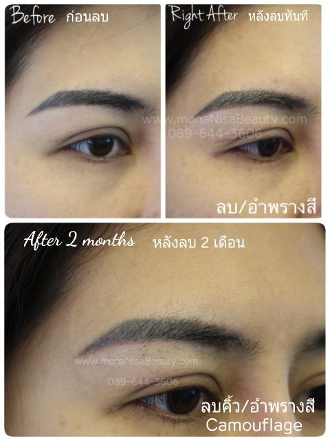 ลบรอยสักคิ้ว ตา ปาก