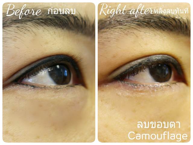 ลบรอยสักคิ้ว ตา ปาก