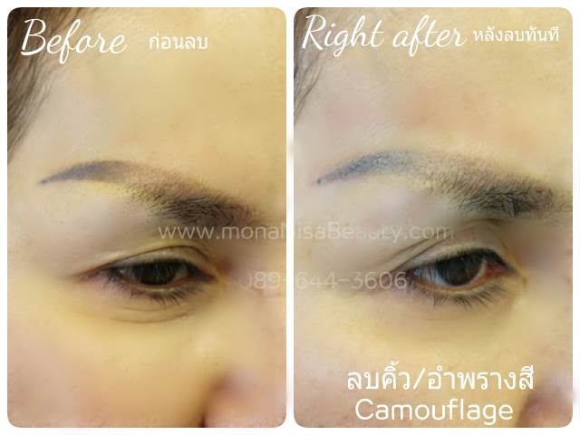 ลบรอยสักคิ้ว ตา ปาก