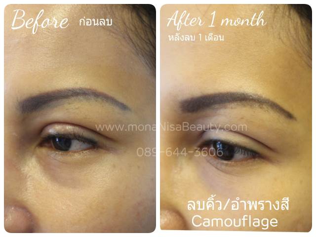 ลบรอยสักคิ้ว ตา ปาก