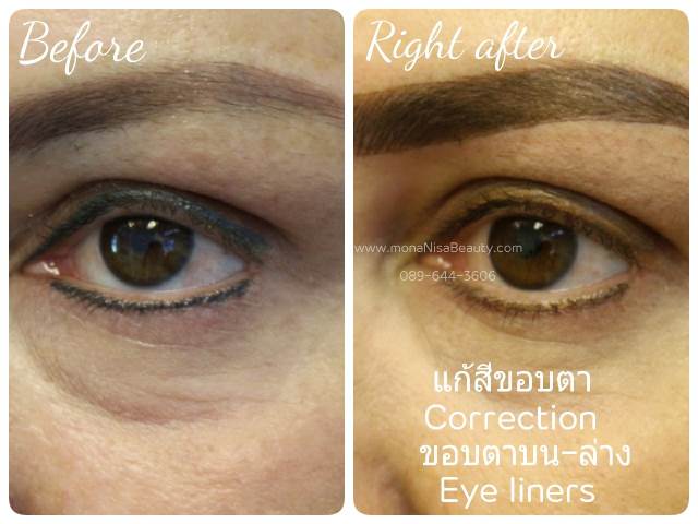 ลบรอยสักคิ้ว ตา ปาก