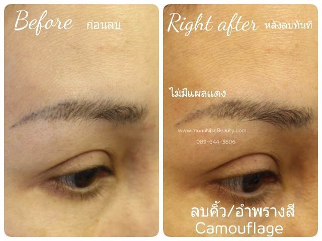 ลบรอยสักคิ้ว ตา ปาก