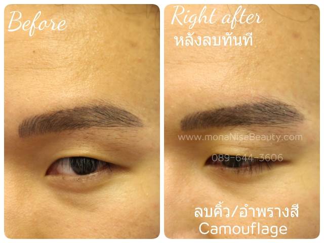 ลบรอยสักคิ้ว ตา ปาก