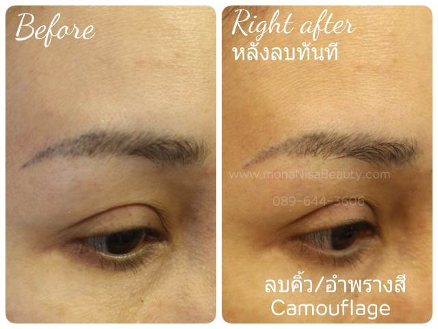 ลบรอยสักคิ้ว ตา ปาก