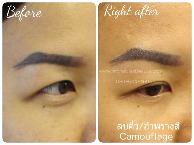 ลบรอยสักคิ้ว ตา ปาก