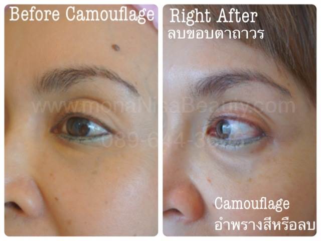 Cosmetic Tattoo Removal