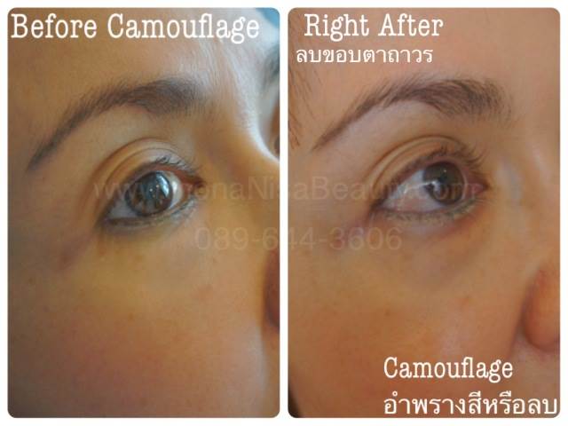 Cosmetic Tattoo Removal