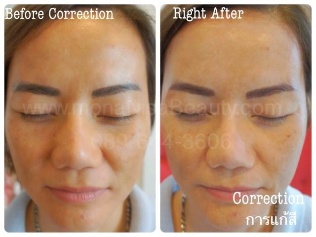 Cosmetic Tattoo Removal