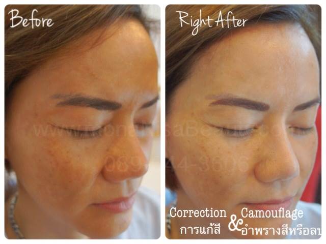 Cosmetic Tattoo Removal