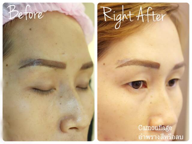 Cosmetic Tattoo Removal