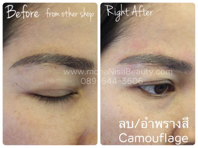 ลบรอยสักคิ้ว ตา ปาก