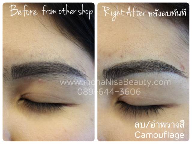 ลบรอยสักคิ้ว ตา ปาก