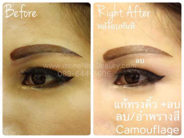 ลบรอยสักคิ้ว ตา ปาก