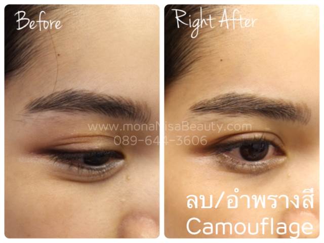 ลบรอยสักคิ้ว ตา ปาก