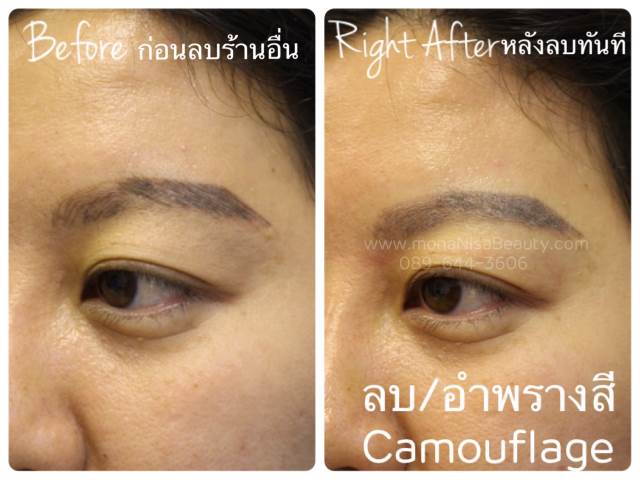 ลบรอยสักคิ้ว ตา ปาก