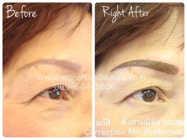 ลบรอยสักคิ้ว ตา ปาก