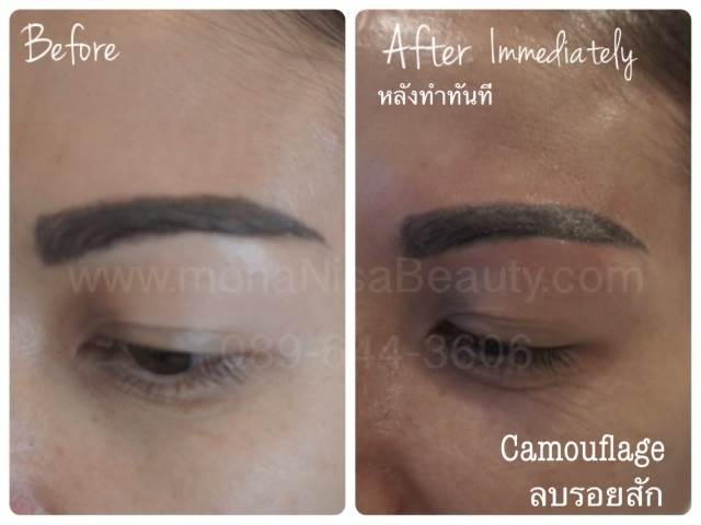 Cosmetic Tattoo Removal