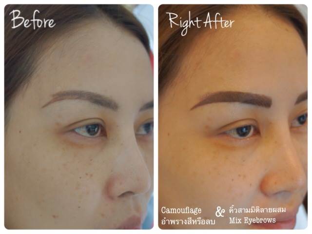 Cosmetic Tattoo Removal