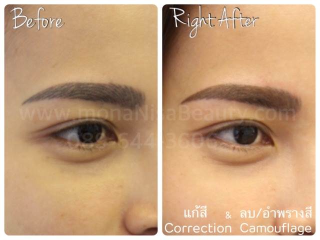 Cosmetic Tattoo Removal