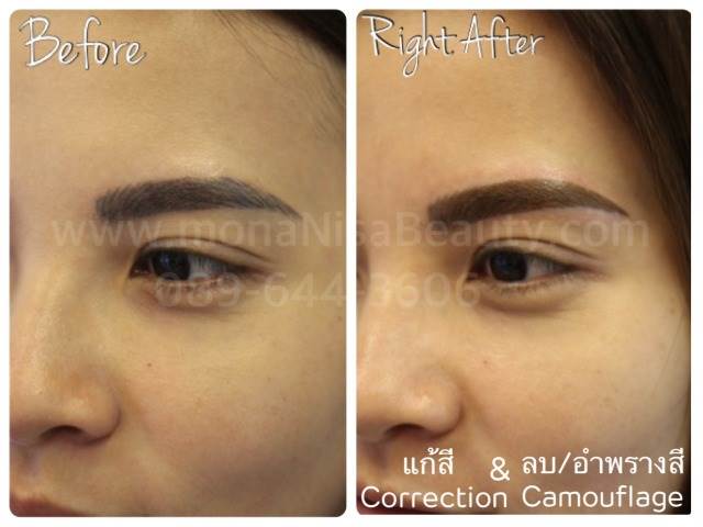 Cosmetic Tattoo Removal