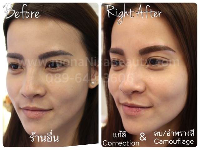 Cosmetic Tattoo Removal