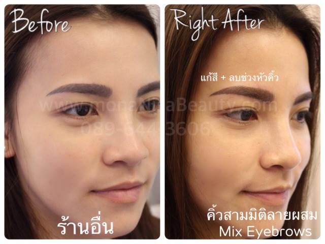 Cosmetic Tattoo Removal