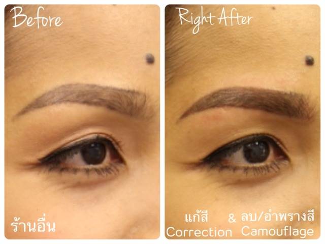 Cosmetic Tattoo Removal
