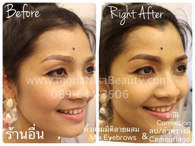 Cosmetic Tattoo Removal
