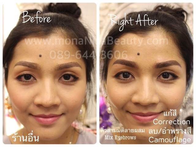 Cosmetic Tattoo Removal