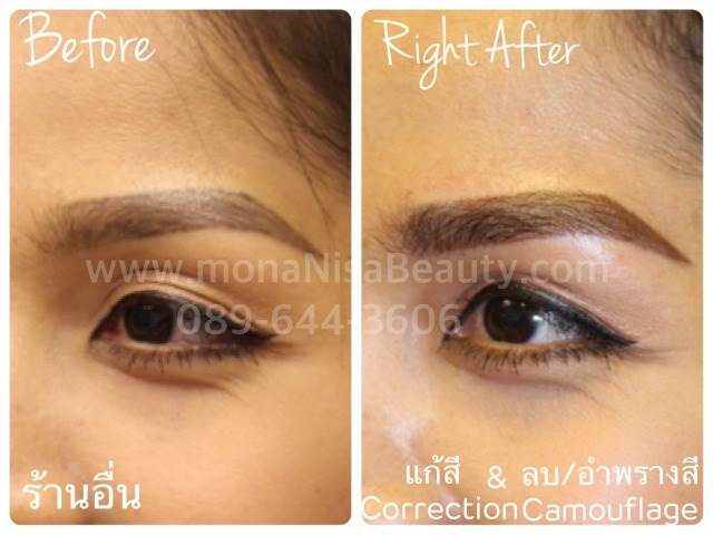 Cosmetic Tattoo Removal