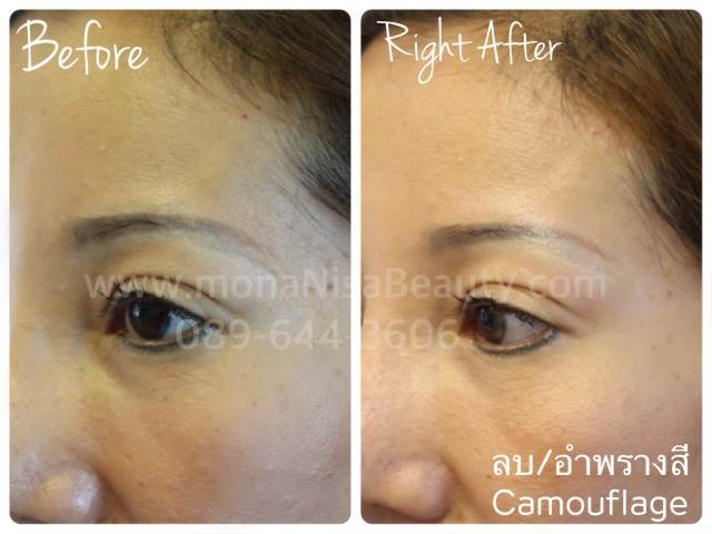 Cosmetic Tattoo Removal