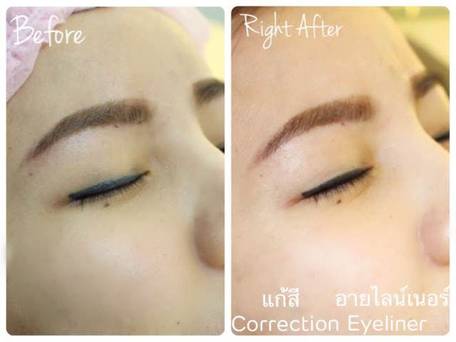 Cosmetic Tattoo Removal
