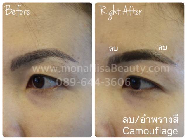 Cosmetic Tattoo Removal