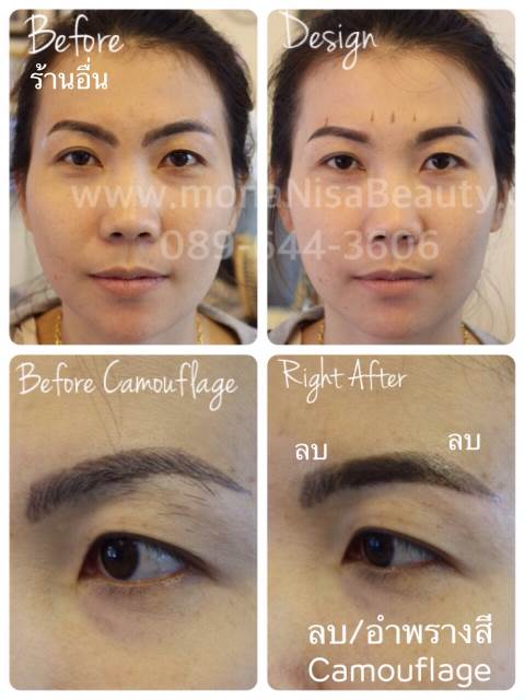 Cosmetic Tattoo Removal