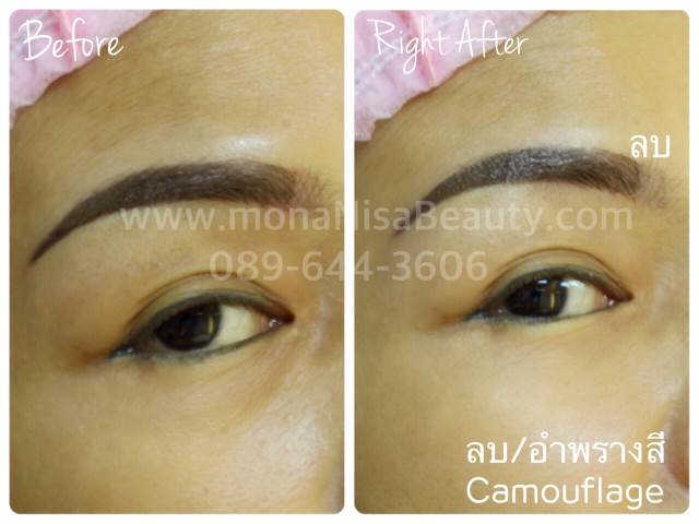 Cosmetic Tattoo Removal