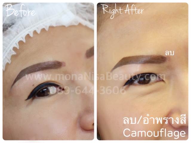 Cosmetic Tattoo Removal