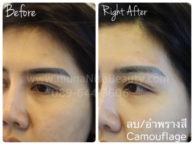 Cosmetic Tattoo Removal