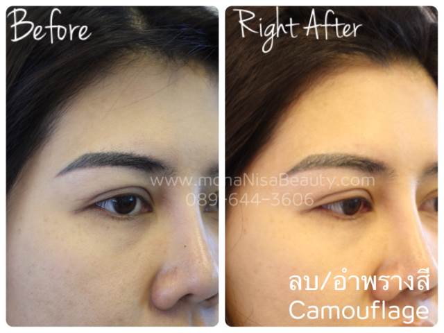 Cosmetic Tattoo Removal