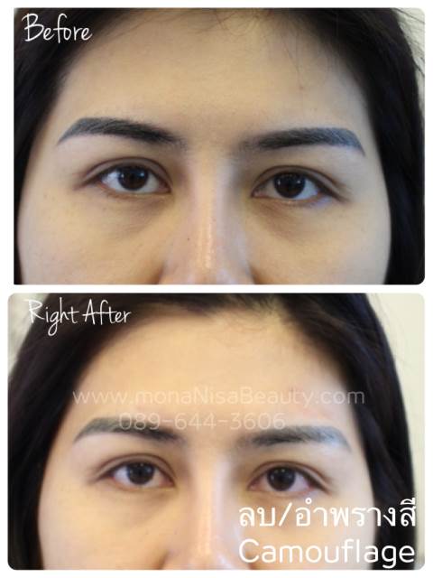 Cosmetic Tattoo Removal